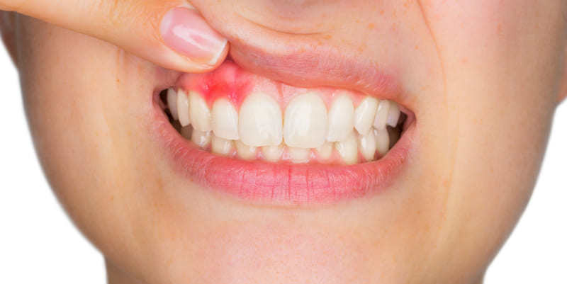 成人の80％が歯周病といわれています
